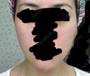 その他（肌） / 再生医療 / PRP皮膚再生療法 聖心美容クリニック 六本木院 DAY 7 サムネイル用