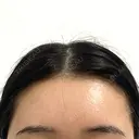 額を丸く / こめかみ形成 / 脂肪注入（額） あつぎ美容クリニック DAY 34 サムネイル用