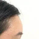 額を丸く / こめかみ形成 / 脂肪注入（額） あつぎ美容クリニック DAY 34 サムネイル用