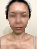 脂肪吸引（顔） / 切開リフト / 脂肪注入（輪郭） 牧野美容クリニック DAY 528 サムネイル用