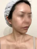 脂肪吸引（顔） / 切開リフト / 脂肪注入（輪郭） 牧野美容クリニック DAY 528 サムネイル用
