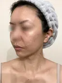 脂肪吸引（顔） / 切開リフト / 脂肪注入（輪郭） 牧野美容クリニック DAY 528 サムネイル用