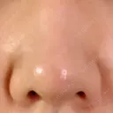 軟骨移植 フェアクリニック川口 AFTER サムネイル用