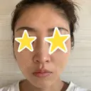 糸リフト 湘南美容クリニック 宇都宮院 DAY 9 サムネイル用