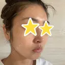 糸リフト 湘南美容クリニック 宇都宮院 DAY 9 サムネイル用