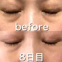 ヒアルロン酸注入（目の下） 渋谷美容外科クリニック 渋谷院 DAY 8 サムネイル用
