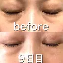 ヒアルロン酸注入（目の下） 渋谷美容外科クリニック 渋谷院 DAY 9 サムネイル用