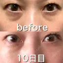 ヒアルロン酸注入（目の下） 渋谷美容外科クリニック 渋谷院 DAY 10 サムネイル用