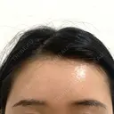 額を丸く / こめかみ形成 / 脂肪注入（額） あつぎ美容クリニック AFTER サムネイル用