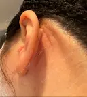 脂肪吸引（顔） / 切開リフト 百人町アルファクリニック DAY 492 サムネイル用