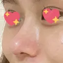 軟骨移植 R.O.clinic DAY 94 サムネイル用