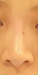 ヒアルロン酸注入（鼻） id美容クリニック 銀座院 AFTER サムネイル用