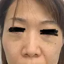 下まぶたの脂肪取り 東郷美容形成外科　福岡 DAY 0 サムネイル用