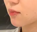 ヒアルロン酸注入（あご） id美容クリニック 銀座院 DAY 0 サムネイル用