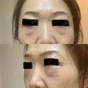 下まぶたの脂肪取り 東郷美容形成外科　福岡 DAY 1 サムネイル用