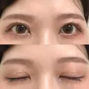二重切開 / その他（目元） LIKI CLINIC KOBE AFTER サムネイル用