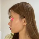 軟骨移植 R.O.clinic DAY 97 サムネイル用