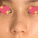 軟骨移植 R.O.clinic DAY 97 サムネイル用