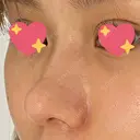 軟骨移植 R.O.clinic DAY 97 サムネイル用