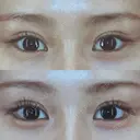 目尻靭帯移動 R.O.clinic DAY 98 サムネイル用