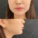 ヒアルロン酸注入（あご） / ボトックス（エラ・小顔） / ボトックス（口角） id美容クリニック 銀座院 AFTER サムネイル用