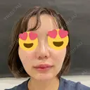 ヒアルロン酸注入（あご） id美容クリニック 銀座院 AFTER サムネイル用