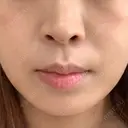 肌ヒアルロン酸注入（たるみ・シワ改善） TCB東京中央美容外科 静岡院 AFTER サムネイル用