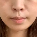 肌ヒアルロン酸注入（たるみ・シワ改善） TCB東京中央美容外科 静岡院 DAY 0 サムネイル用