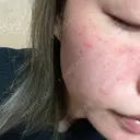 ヴェルヴェットスキン ルラ美容クリニック 大宮院 / ルラスキンクリニック 大宮院 DAY 1 サムネイル用