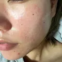 ヴェルヴェットスキン ルラ美容クリニック 大宮院 / ルラスキンクリニック 大宮院 DAY 2 サムネイル用