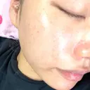 ヴェルヴェットスキン ルラ美容クリニック 大宮院 / ルラスキンクリニック 大宮院 AFTER サムネイル用