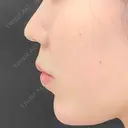 レディエッセ注入（あご） id美容クリニック 銀座院 AFTER サムネイル用