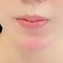 レディエッセ注入（あご） id美容クリニック 銀座院 DAY 0 サムネイル用