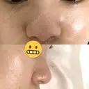 隆鼻術 JUN CLINIC AFTER サムネイル用