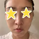 糸リフト 湘南美容クリニック 宇都宮院 DAY 32 サムネイル用