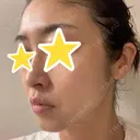 糸リフト 湘南美容クリニック 宇都宮院 DAY 32 サムネイル用