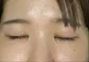 目頭切開 eクリニック 金沢本院 DAY 14 サムネイル用