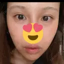 ヒアルロン酸注入（涙袋） / ヒアルロン酸注入（唇） / ボトックス（口角） / ボトックス（人中） HAAB×DREAM BEAUTY CLINIC 東京本院 DAY 0 サムネイル用