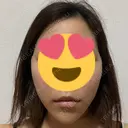 糸リフト / ヒアルロン酸注入（あご） 大阪消化器内科・内視鏡クリニック難波院 DAY 0 サムネイル用