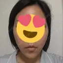 糸リフト / ヒアルロン酸注入（あご） 大阪消化器内科・内視鏡クリニック難波院 AFTER サムネイル用