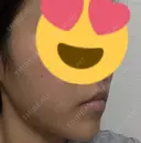 糸リフト / ヒアルロン酸注入（あご） 大阪消化器内科・内視鏡クリニック難波院 DAY 7 サムネイル用