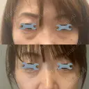 下まぶたの脂肪取り 東郷美容形成外科　福岡 DAY 14 サムネイル用