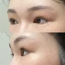 二重切開 / 目頭切開 / 眼瞼下垂（切開） / 上まぶたの脂肪取り 銀座マイアミ美容外科 DAY 506 サムネイル用