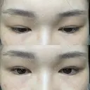 二重切開 / 目頭切開 / 眼瞼下垂（切開） / 上まぶたの脂肪取り 銀座マイアミ美容外科 DAY 506 サムネイル用