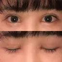 二重埋没 / 目頭切開 / 上まぶたの脂肪取り 湘南美容クリニック 柏院 AFTER サムネイル用