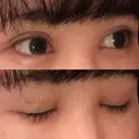 二重埋没 / 目頭切開 / 上まぶたの脂肪取り 湘南美容クリニック 柏院 DAY 27 サムネイル用