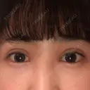 二重埋没 / 目頭切開 / 上まぶたの脂肪取り 湘南美容クリニック 柏院 DAY 19 サムネイル用