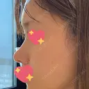 軟骨移植 R.O.clinic AFTER サムネイル用