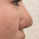 隆鼻術 / 鼻尖形成（切開） / 小鼻縮小（切開） / 軟骨移植 フェアクリニック川口 DAY 357 サムネイル用