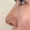 隆鼻術 / 鼻尖形成（切開） / 小鼻縮小（切開） / 軟骨移植 フェアクリニック川口 DAY 357 サムネイル用